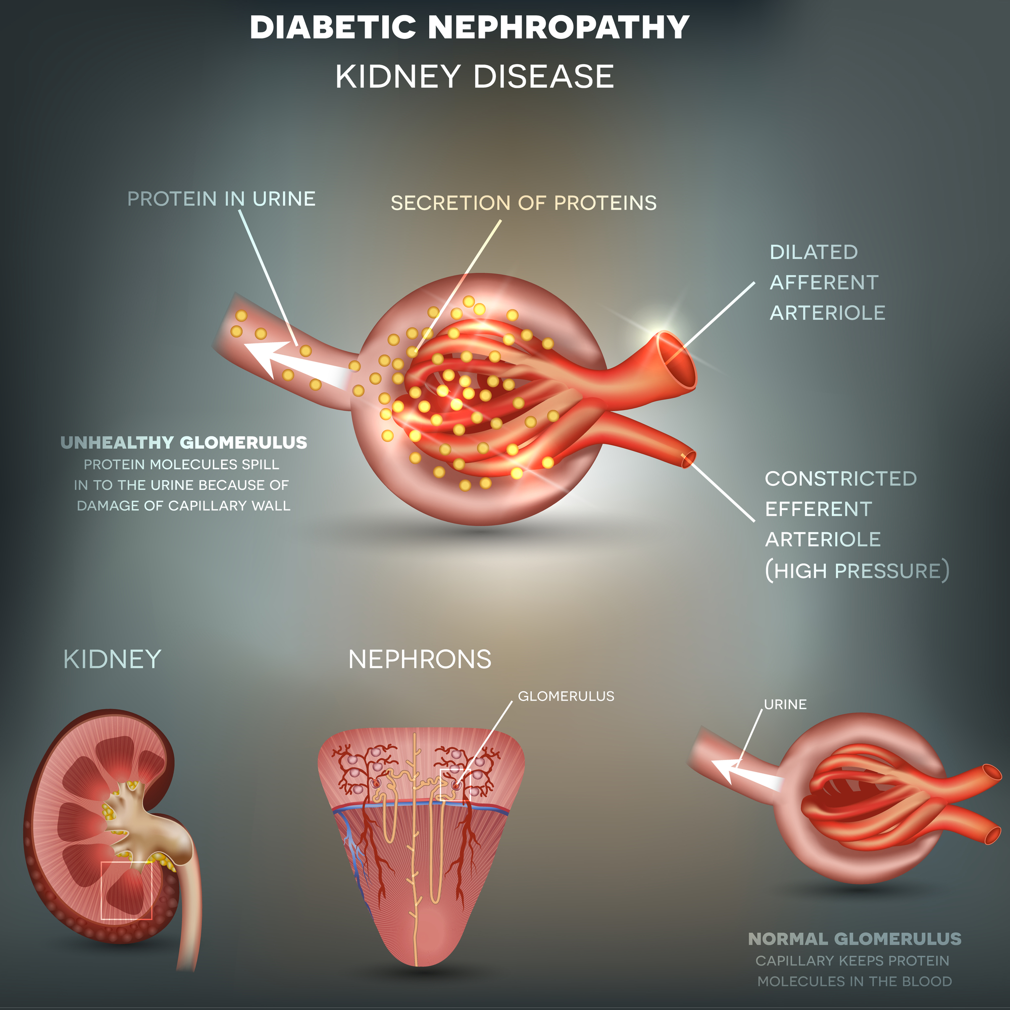 Diabetic Nephropathy, kidney disease caused by Diabetes. 